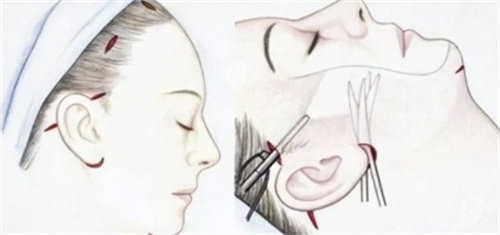 上海伯思立医疗美容价格一览：眼鼻整形、吸脂、隆胸、拉皮项目费用全公开！