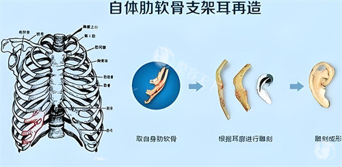 张正文耳再造技术咋样？取肋软骨量比较少，术后瘢痕隐蔽且改善较快！