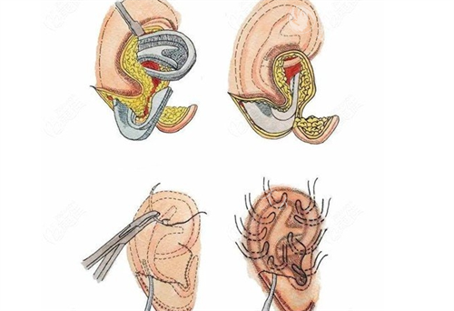 庄洪兴耳再造咋样？一文可查清医生简介、耳再造手术技术、术后成效、口碑评价！
