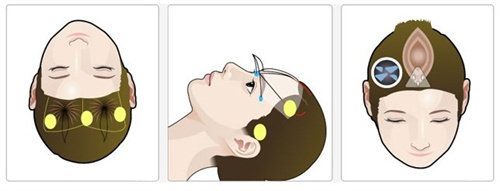 上海华美眼部筋膜提升咋样​？结合求美者的眼型、脸型和整体型像，制定专属方案