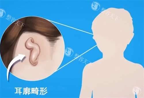张正文耳再造技术咋样？取肋软骨量比较少，术后瘢痕隐蔽且改善较快！