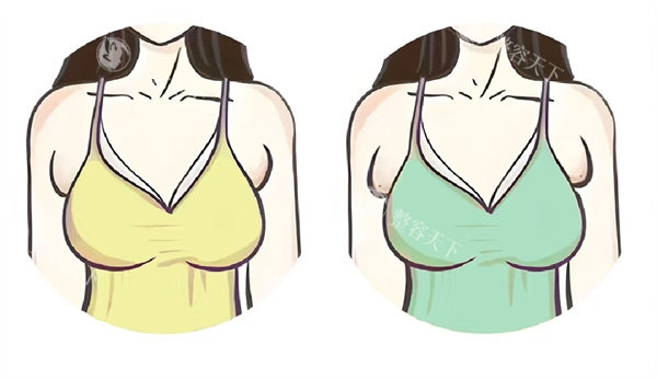 副乳切除适合哪些人？5类人群需特别注意，看看你是否符合条件