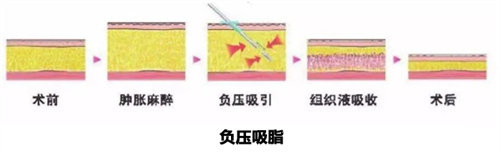 阜阳市抽脂手术哪家医院靠谱？专科医生+真实术例，帮你避坑选对医院！