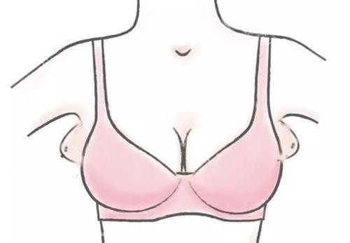 副乳切除手术原理揭秘：30年经验整形医生详解脂肪与腺体处理技术