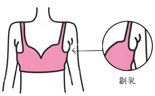 副乳切除手术原理揭秘：30年经验整形医生详解脂肪与腺体处理技术