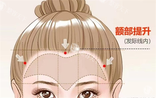 上海华美眼部筋膜提升咋样​？结合求美者的眼型、脸型和整体型像，制定专属方案