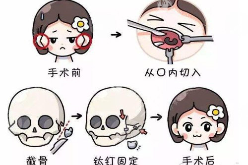 李继华颧骨技术好吗？小创口操作+3D定位，颧弓内推避免松弛，技术亮点与用户反馈足以证实实力！
