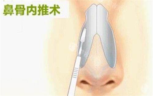 成都王运平医生做鼻子怎么样？近20年临床经验/手术操作严谨/自体软骨隆鼻、鼻综合更擅长！