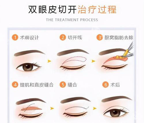 西安美莱柏国芳的口碑如何？来看她做全切双眼皮、眼修复的真实实例与评价