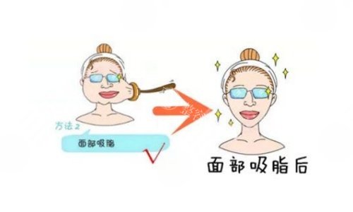 王东吸脂技术怎么样​？会综合考虑大腿和臀部的脂肪分布，确定吸脂范围和吸脂量