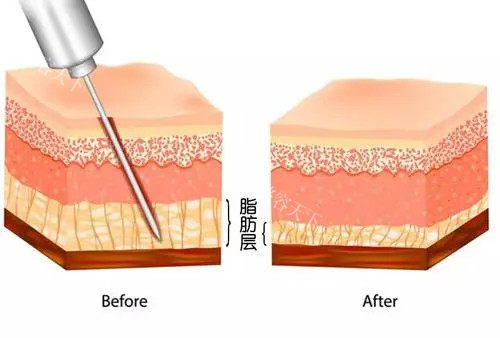 娇点医学美容医院到底好不好？手术资质齐全/吸脂、隆胸是热选项目/含技术优势介绍！