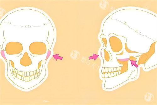 李继华颧骨技术好吗？小创口操作+3D定位，颧弓内推避免松弛，技术亮点与用户反馈足以证实实力！