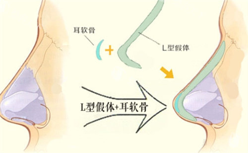 成都王运平医生做鼻子怎么样？近20年临床经验/手术操作严谨/自体软骨隆鼻、鼻综合更擅长！