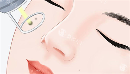 点痣去医院挂哪个科室？皮肤科或医疗美容科，附在线挂号预约方式！