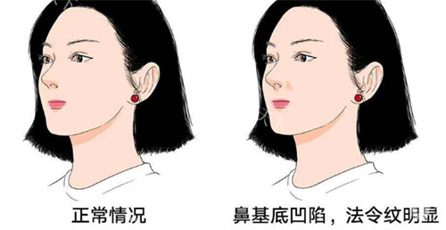 牛永敢做鼻修复多少钱？网友分享找牛永敢做二次鼻修复经历，总费用大概60000左右