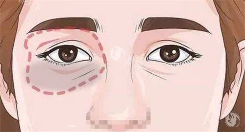 上海眼袋手术哪家医院靠谱？爱丽姿整形/海华整形/爱尚丽格整形/艺星整形五家技术靠谱！