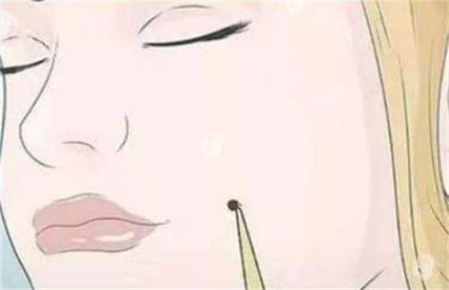 点痣去医院挂哪个科室？皮肤科或医疗美容科，附在线挂号预约方式！