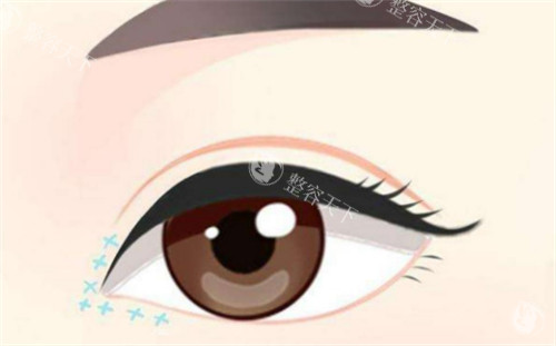 近期想在北京做眼部手术？2025这篇双眼皮价格攻略让你心里有数，不花冤枉钱！