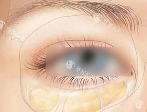 上海眼袋手术哪家医院靠谱？爱丽姿整形/海华整形/爱尚丽格整形/艺星整形五家技术靠谱！