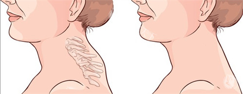 富贵包去除的三大黄金优势：创伤小、修养快、结果立竿见影