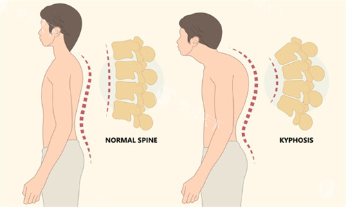富贵包去除的三大黄金优势：创伤小、修养快、结果立竿见影