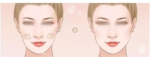 王明利医生做脂肪填充好吗？技术、结果、口碑全解析！