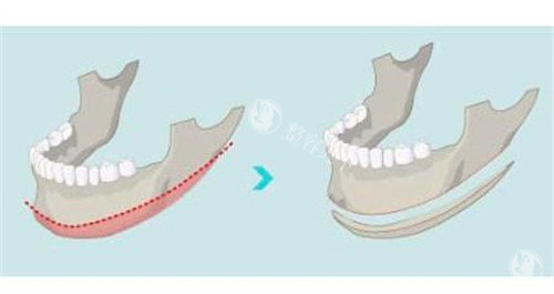 南宁袁伟医生做磨骨手术怎么样？袁伟做磨骨多年经验还是蛮多的！
