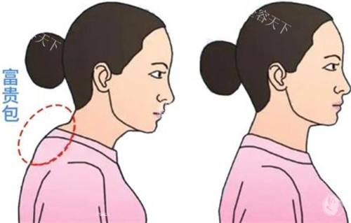 富贵包术后成效对比：从“驼背”到“直角肩”的惊艳蜕变实录