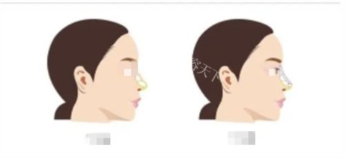 师俊莉医生做鼻子怎么收费的？注射8000+假体15000+自体软骨39800+鼻修复50000+