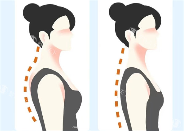 曹孟君做富贵包手术无投诉实例：只因成效佳、术后反弹小且不留疤痕