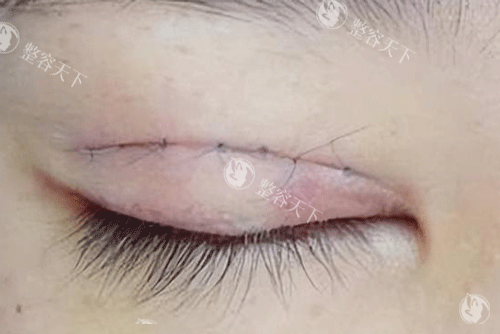 南宁彭劲松医生技术好吗？做医美好 眼鼻和胸都是擅长项目！