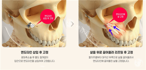 南宁袁伟医生做磨骨手术多少钱？单个部位报价3.5万元起！