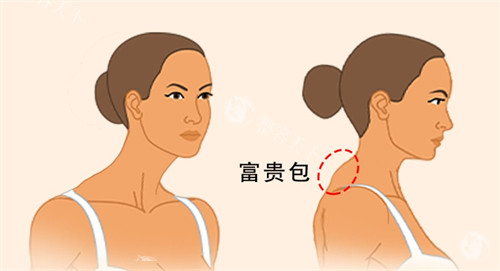富贵包术后成效对比：从“驼背”到“直角肩”的惊艳蜕变实录