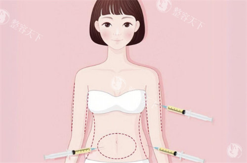 哈尔滨吸脂塑形医院排名|亿术/美之约病例实测，腰腹大腿环吸哪家性价比更高？选院技巧公开！