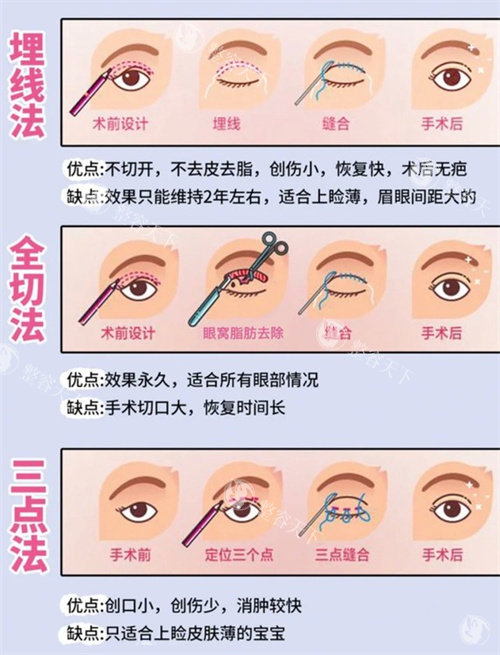 郑州郭晓光做双眼皮大概多少钱？初眼8800+修复9800+贵就贵在定制和自然