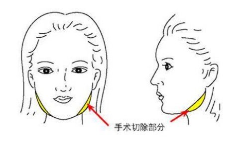 【收藏级】杨君毅磨骨多少钱一个部位？一篇看懂上海磨骨大佬真实报价+避坑攻略！