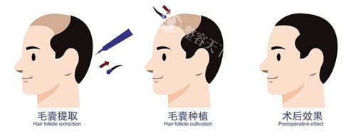南昌国丹植发多少钱?微针植发费用透明曝光:1000单位毛囊亲民起价方案合理!