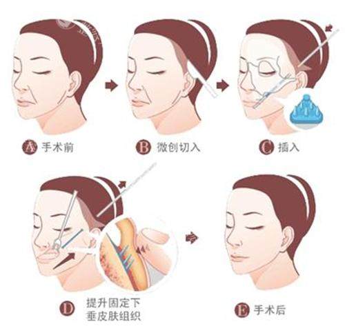 上海拉皮李峰院长怎么样？有多年的丰富临床经验、拉皮手术有口碑、擅长SMAS筋膜层复位技术！