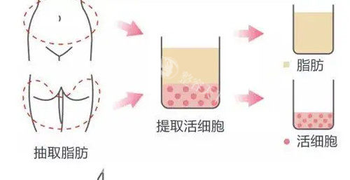 李永峰吸脂真实实例：郑州欧华术后结果，腹部变化图+改善经验！