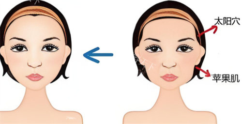 南宁袁伟医生做磨骨多少钱啊？下颌角磨骨3-5万起，术前3D模拟+咬肌处理打造自然流畅线条