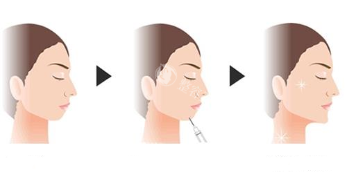 欣德美玻尿酸和伊婉哪个好？一篇给你扒到底的“省钱+变漂亮”攻略！