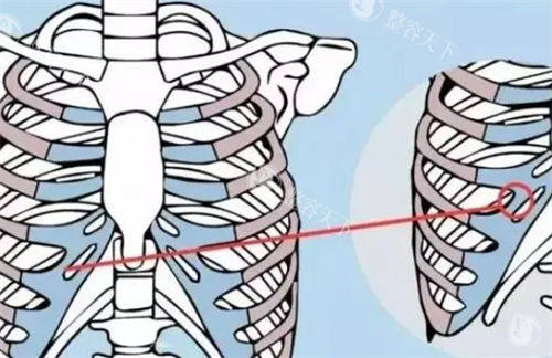 深圳文丰医生鼻整形多少钱？3-5万详细价目表公开，肋软骨隆鼻4万起，附术后自然结果实例分享