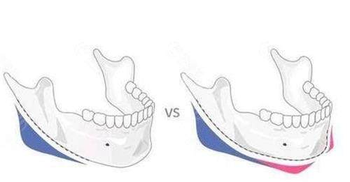 磨骨医院挑选指南：认准四级手术资质+20年经验医生团队！