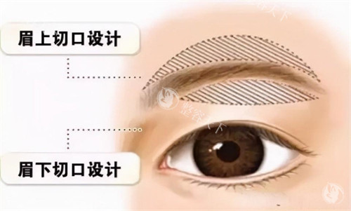 北京2025提眉术/切眉术价格表：提眉3000元起/切眉4500元起/性价比高