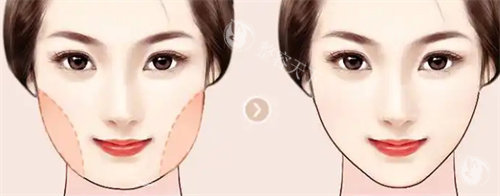 北京伊思凯丽医疗美容吸脂实力大揭秘！医师经验熟练，精细操作塑造理想曲线，别错过！
