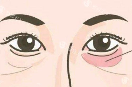 西安艺星宋蔚做眼睛怎么样？一篇给你讲透！