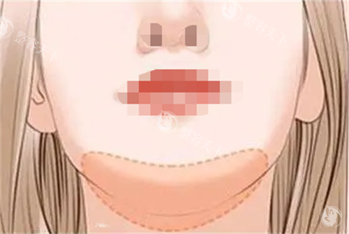 广州打玻尿酸哪家医院好?军美整形/曙光医美技术好,瑞蓝3500元起,可查真实评价