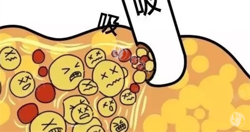 成都军大蒲小兵做吸脂怎么样？从业20年分层吸脂医生解析：面部动态调整技术如何做到3天上班不戴头套