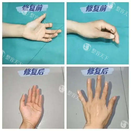断指再植手术成功概率高吗？≈85%？黄金6小时+血管吻合技术是关键~