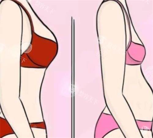 成都隆胸假体取出哪家医院好？成都华美紫馨/美莱医生团队揭秘，小创口技术比较准取出假体不伤乳腺组织！